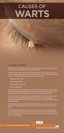 Warts Causes Symptoms Characteristics And Treatment 