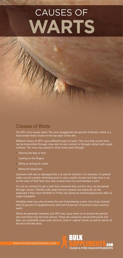 Warts Causes Symptoms Characteristics And Treatment