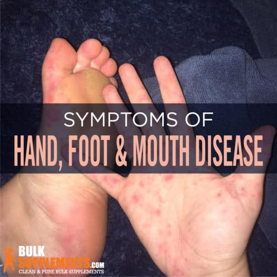 Hand, Foot, and Mouth Disease (HFMD) Symptoms, Causes & Treatment