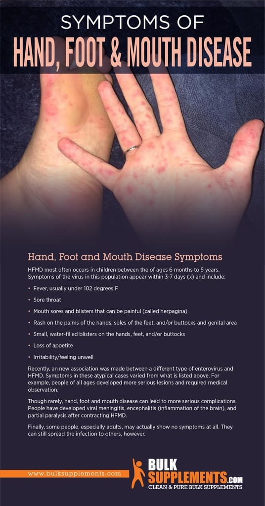 Hand Foot And Mouth Disease Hfmd Symptoms Causes And Treatment By
