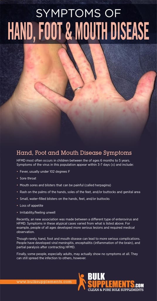 hand-foot-and-mouth-disease-hfmd-pediatric-associates-of