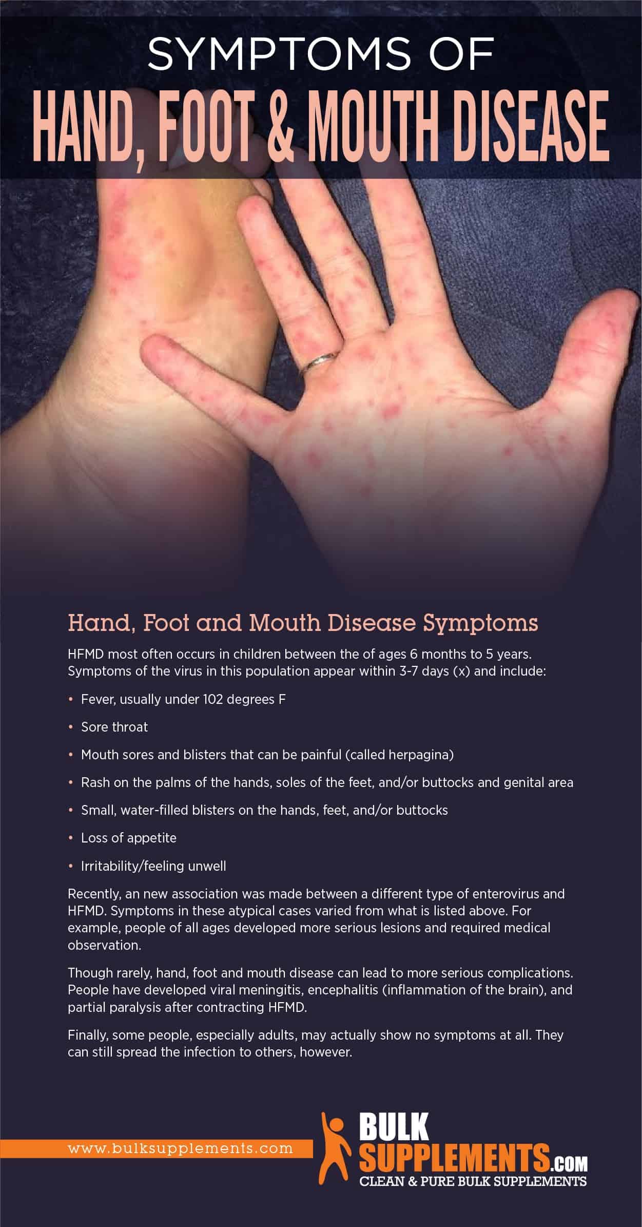 Symptoms of Hand, Foot & Mouth Disease