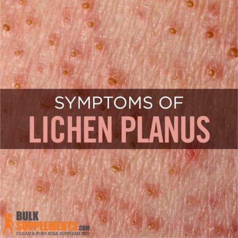 Lichen Planus. it's Time for Relief. Treatment for Rashes & Dental Pain