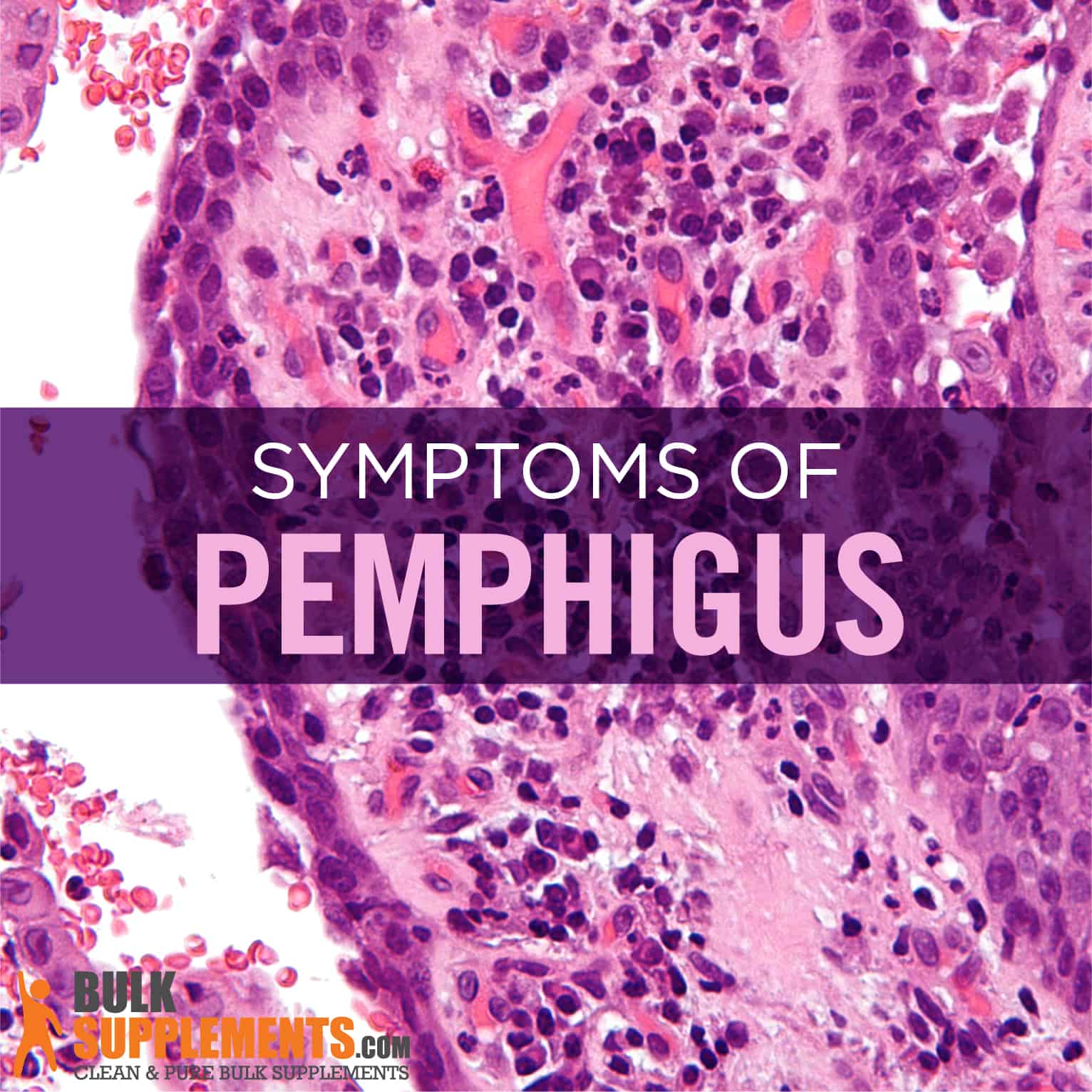 Paraneoplastic Pemphigus Histology