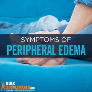 Peripheral Edema: Symptoms, Causes & Treatment