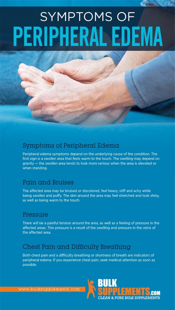Peripheral Edema Symptoms, Causes & Treatment