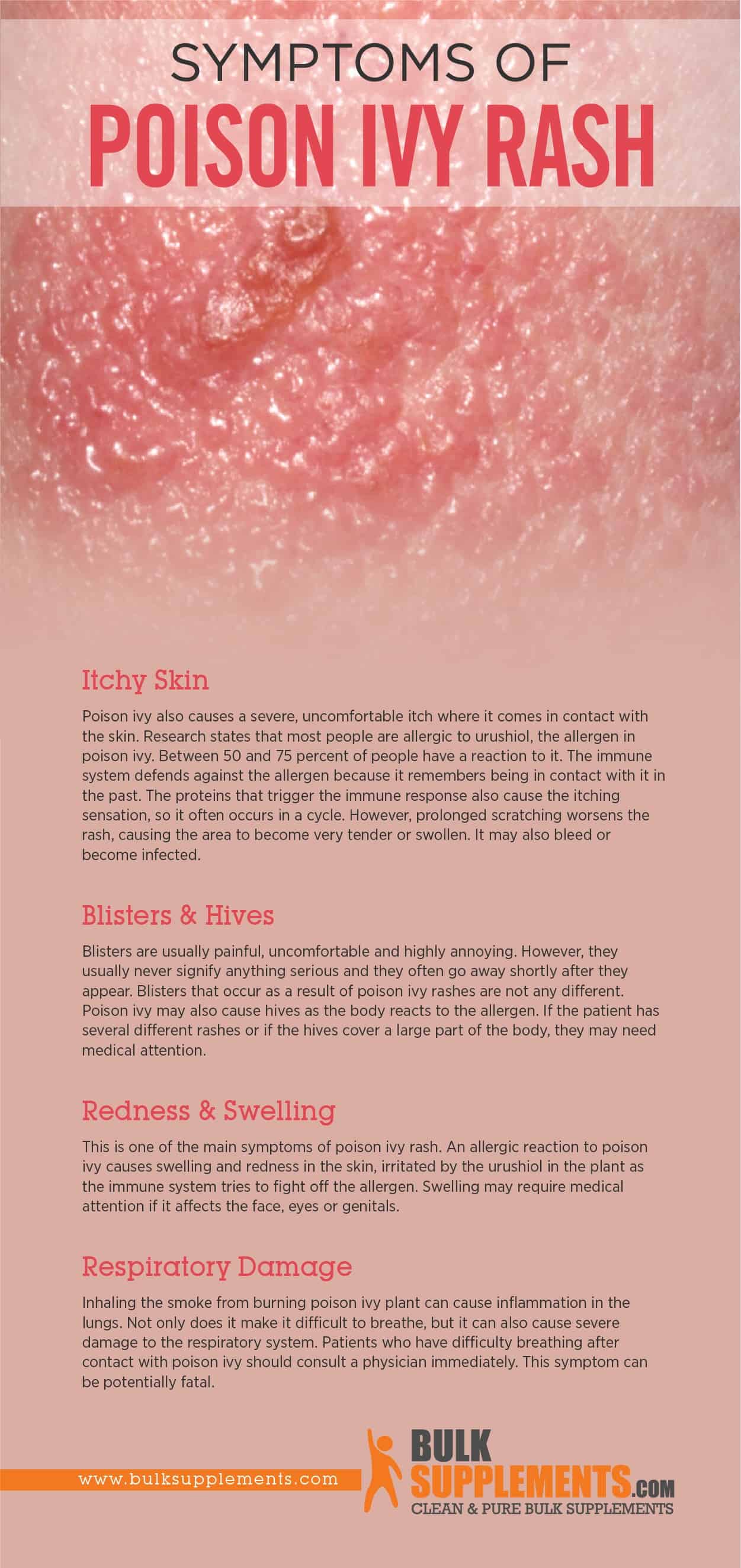 Symptoms of Poison Ivy Rash