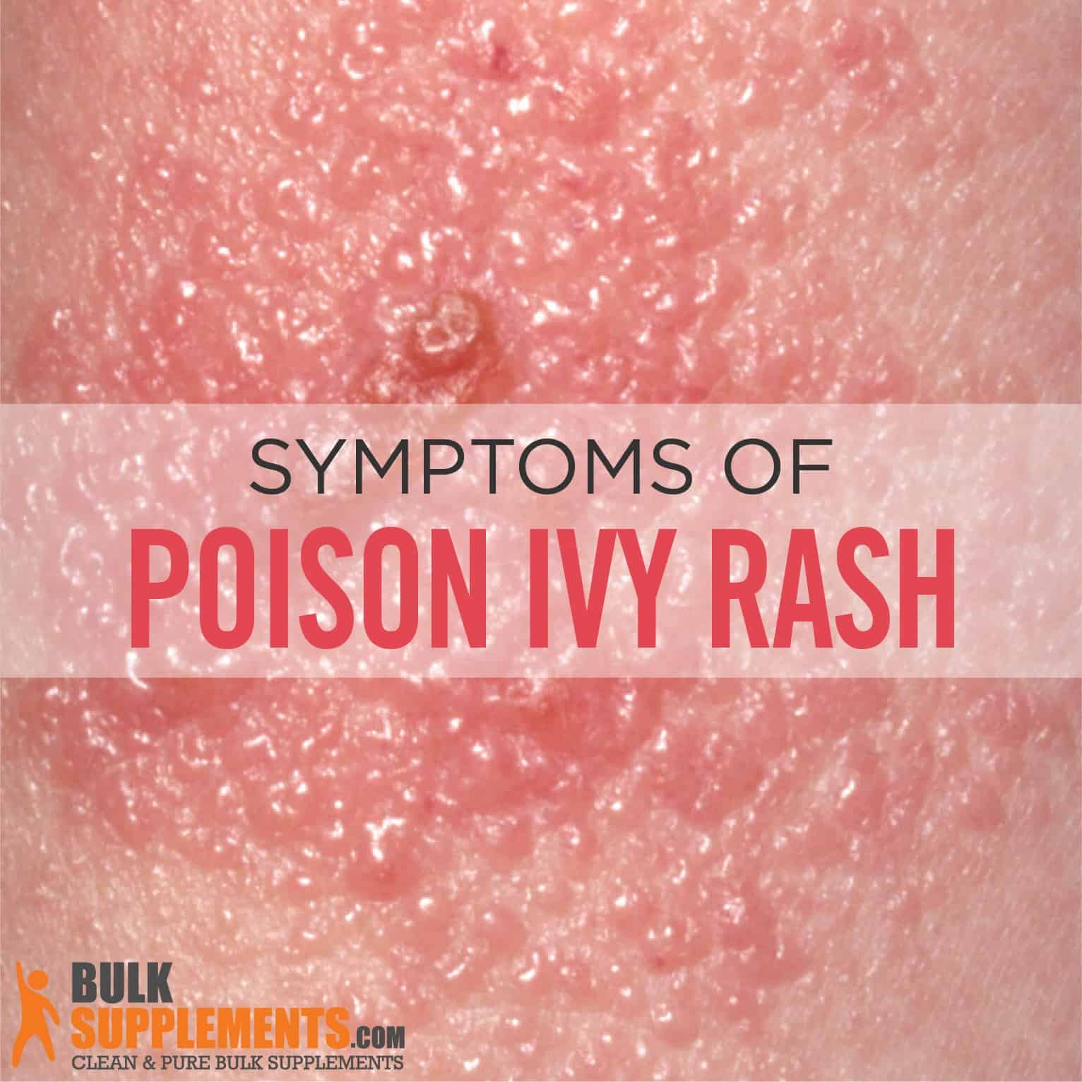 Poison Ivy Rash Symptoms Stages