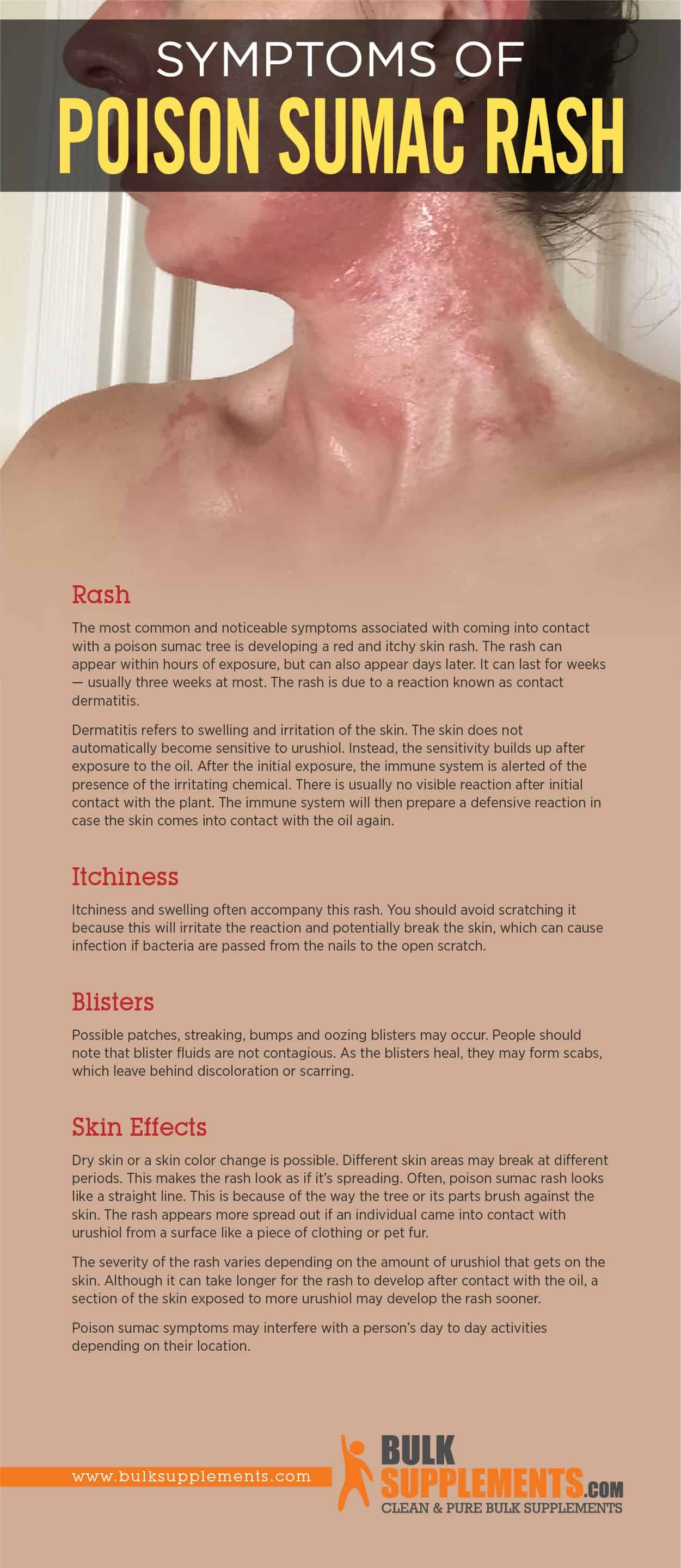 Symptoms of Poison Sumac Rash