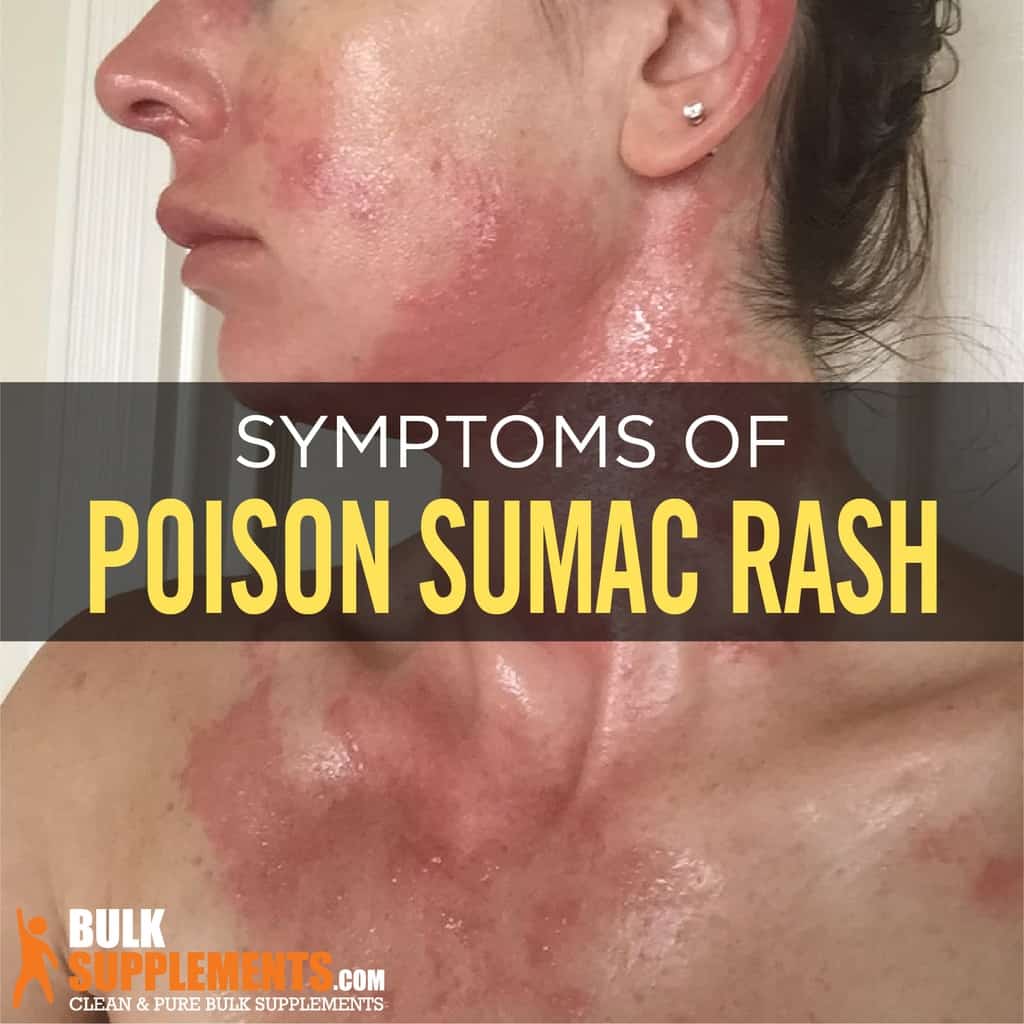 Poison Ivy Rash, Poison Oak, Poison Sumac: Symptoms, Causes