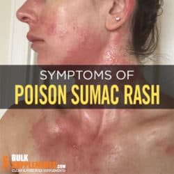 Stages Of Poison Ivy Healing