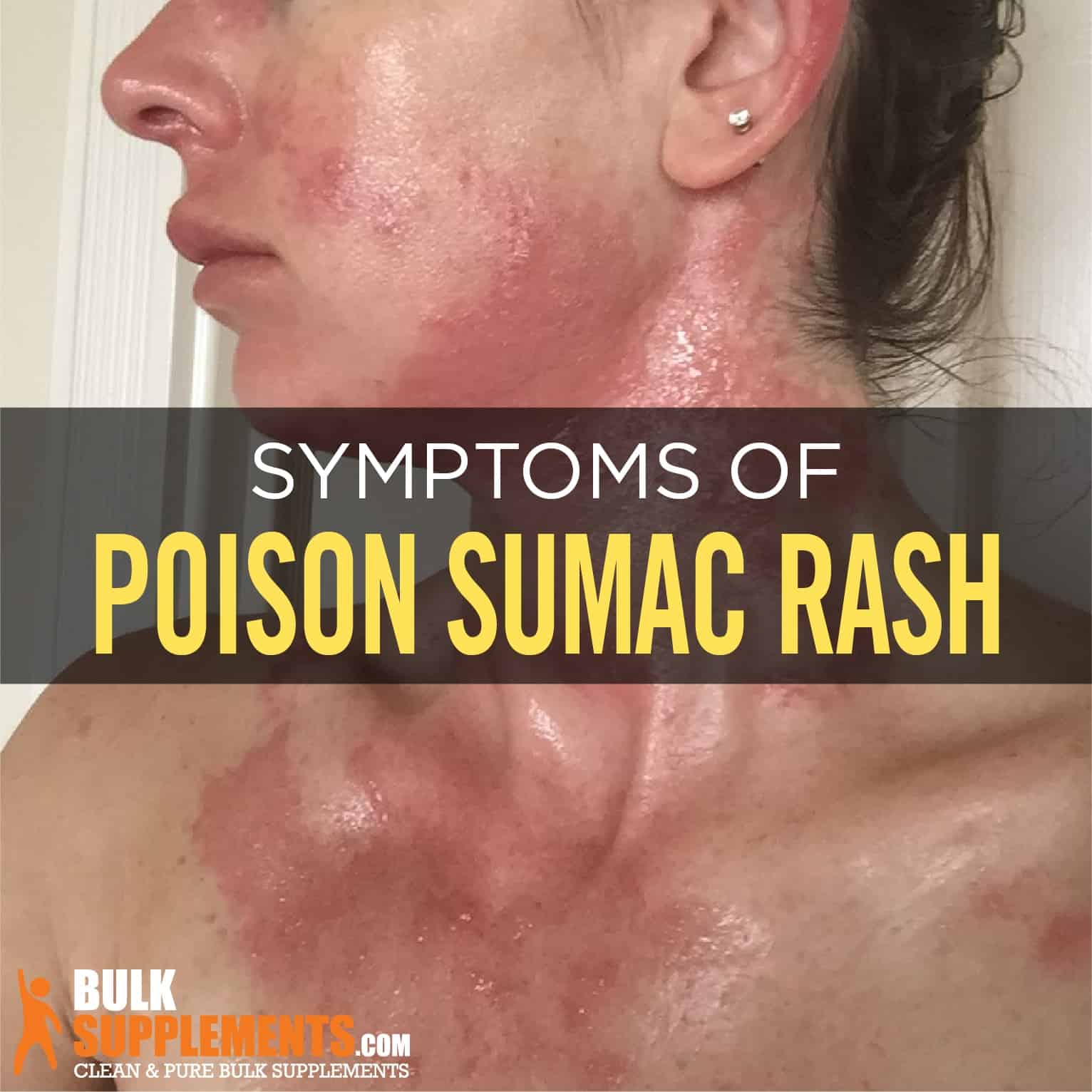 Poison Oak Rash On Face