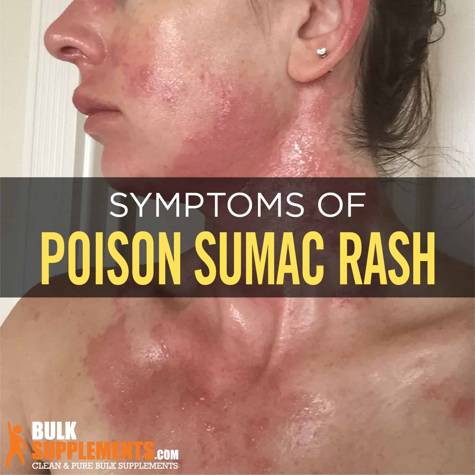 Poison Sumac Leaf Scars Infoupdate