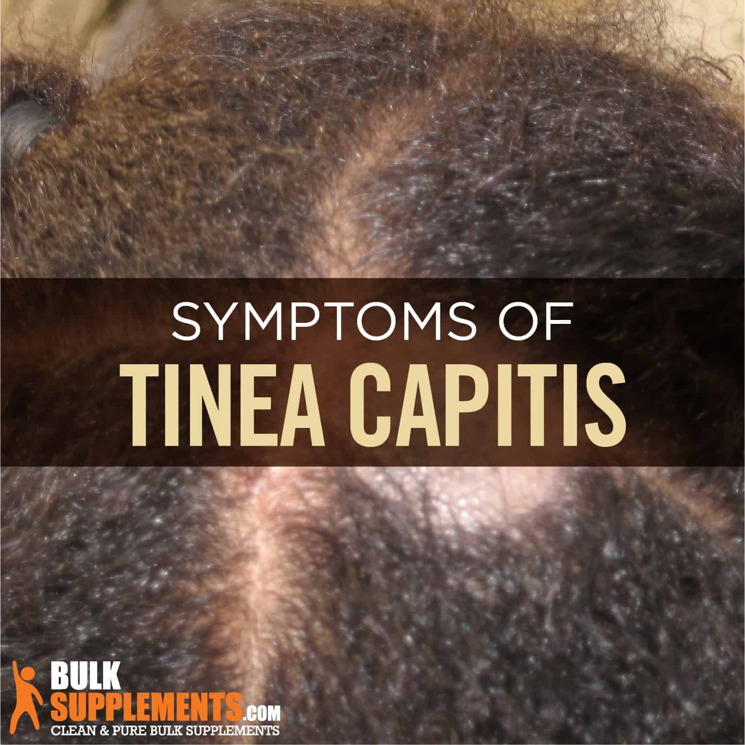 Tinea Capitis (Ringworm of the Scalp): Causes, Symptoms & Treatment