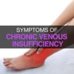 Chronic Venous Insufficiency. Get Relief & Say Goodbye to Leg Pain!