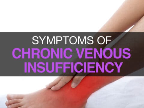 chronic venous insufficiency symptoms Archives
