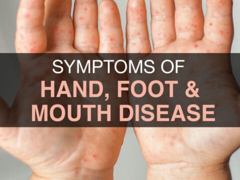 SYMPTOMS OF HAND, FOOT, AND MOUTH DISEASE (HFDM)