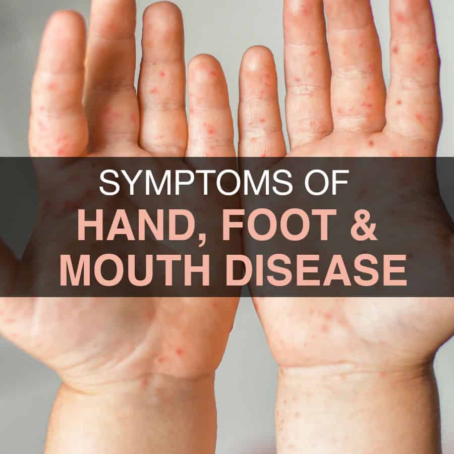 SYMPTOMS OF HAND, FOOT, AND MOUTH DISEASE (HFDM)