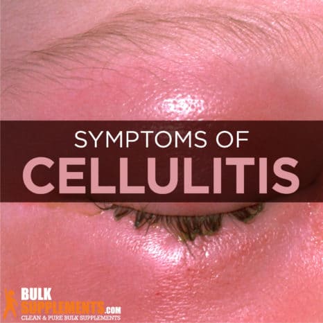 Cellulitis: Symptoms, Causes & Treatment