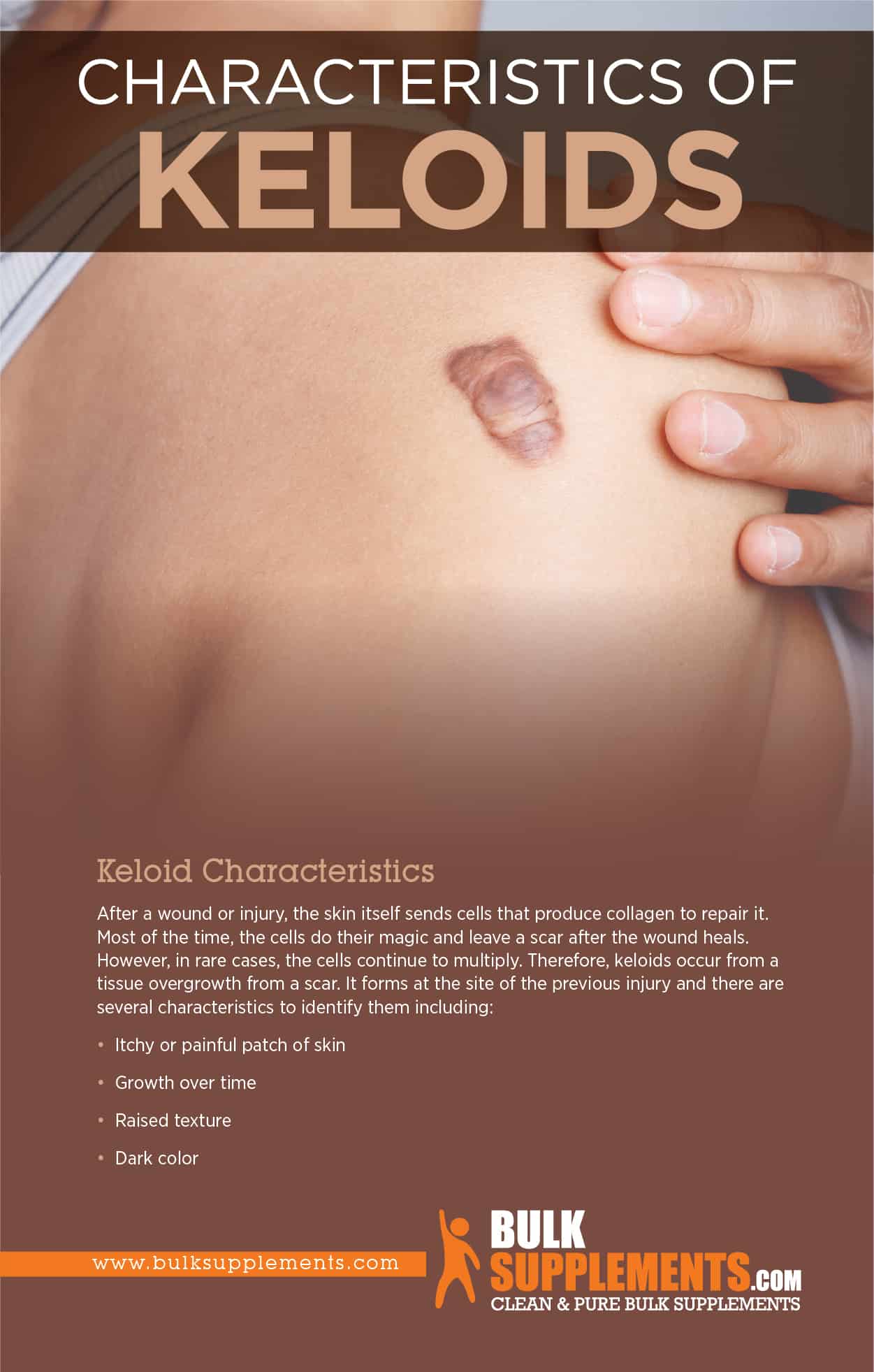 Characteristics of Keloids