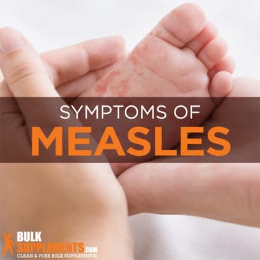 Measles: Symptoms, Causes & Treatment