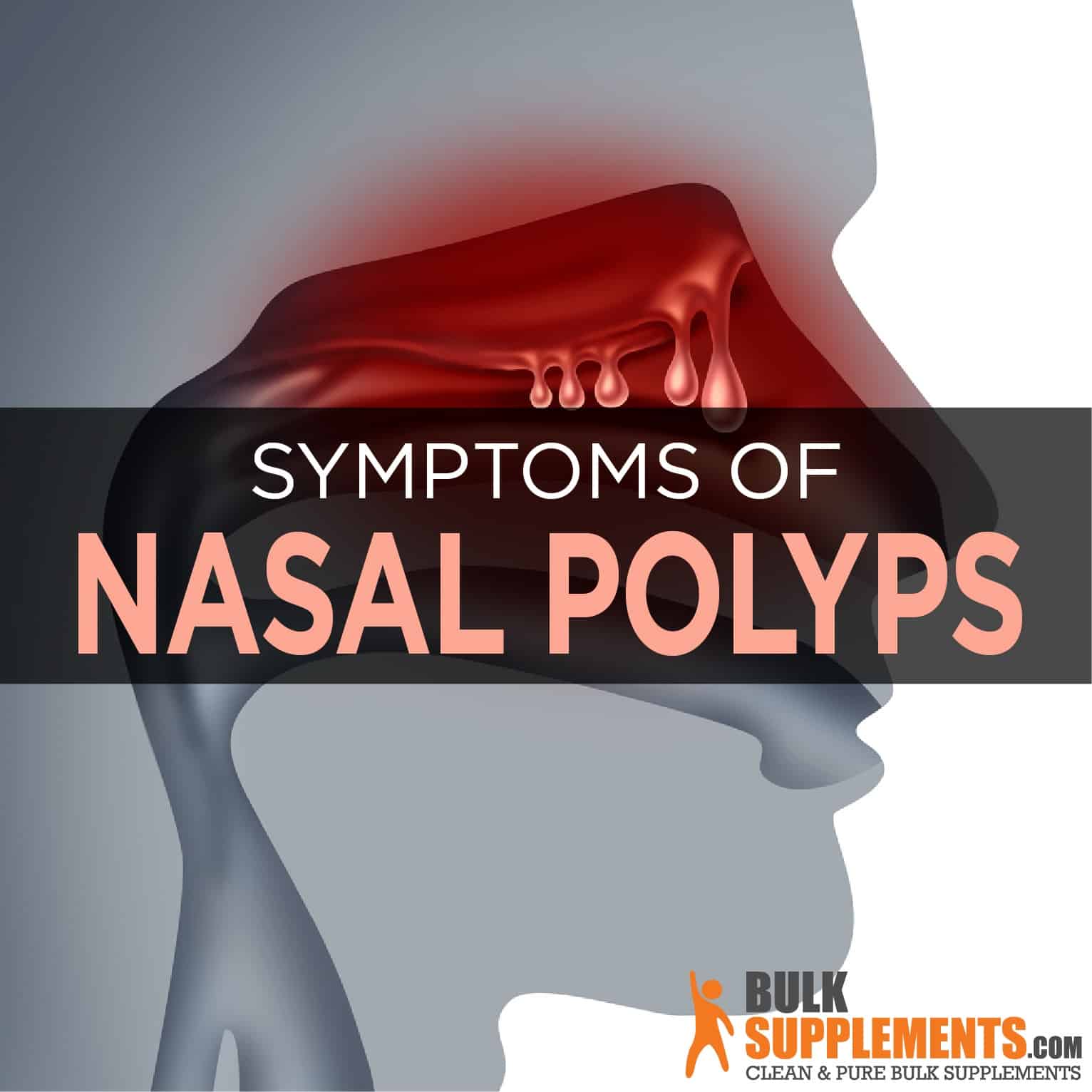 Nasal Polyps: Symptoms, Causes & Treatment by James Denlinger