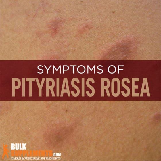 Pityriasis Rosea Symptoms, Causes & Treatment