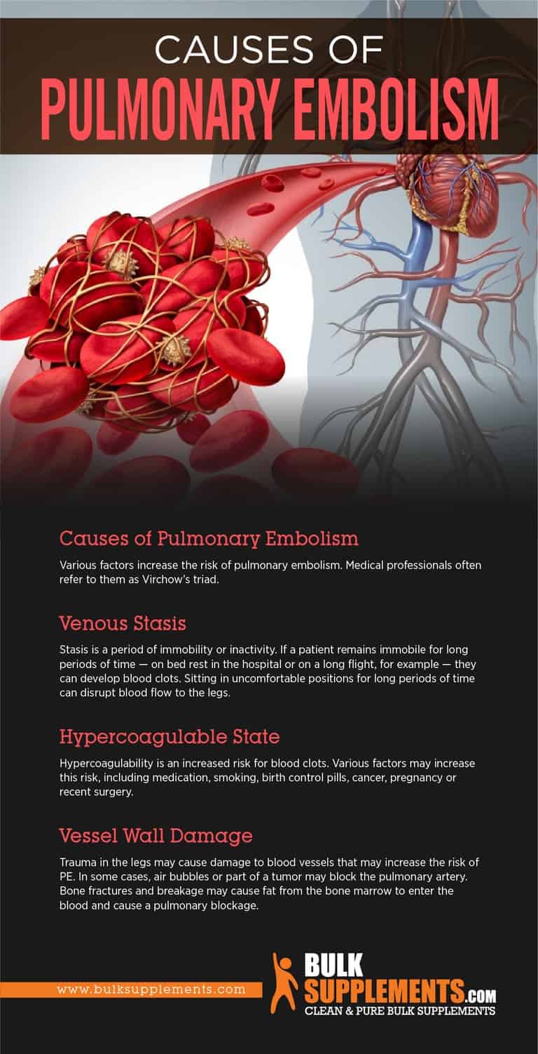 Pulmonary Embolism Infographic