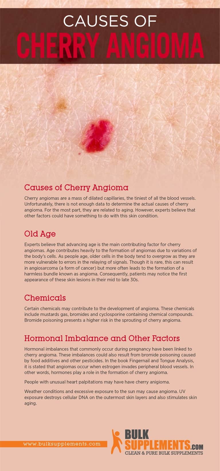 Cherry Angioma: Characteristics, Causes & Treatment