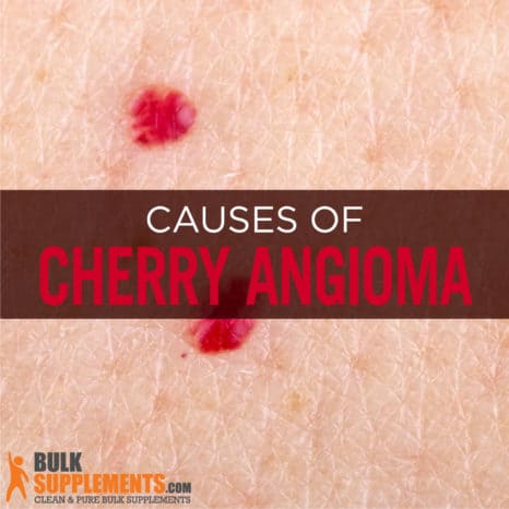 Cherry Angioma: Characteristics, Causes & Treatment