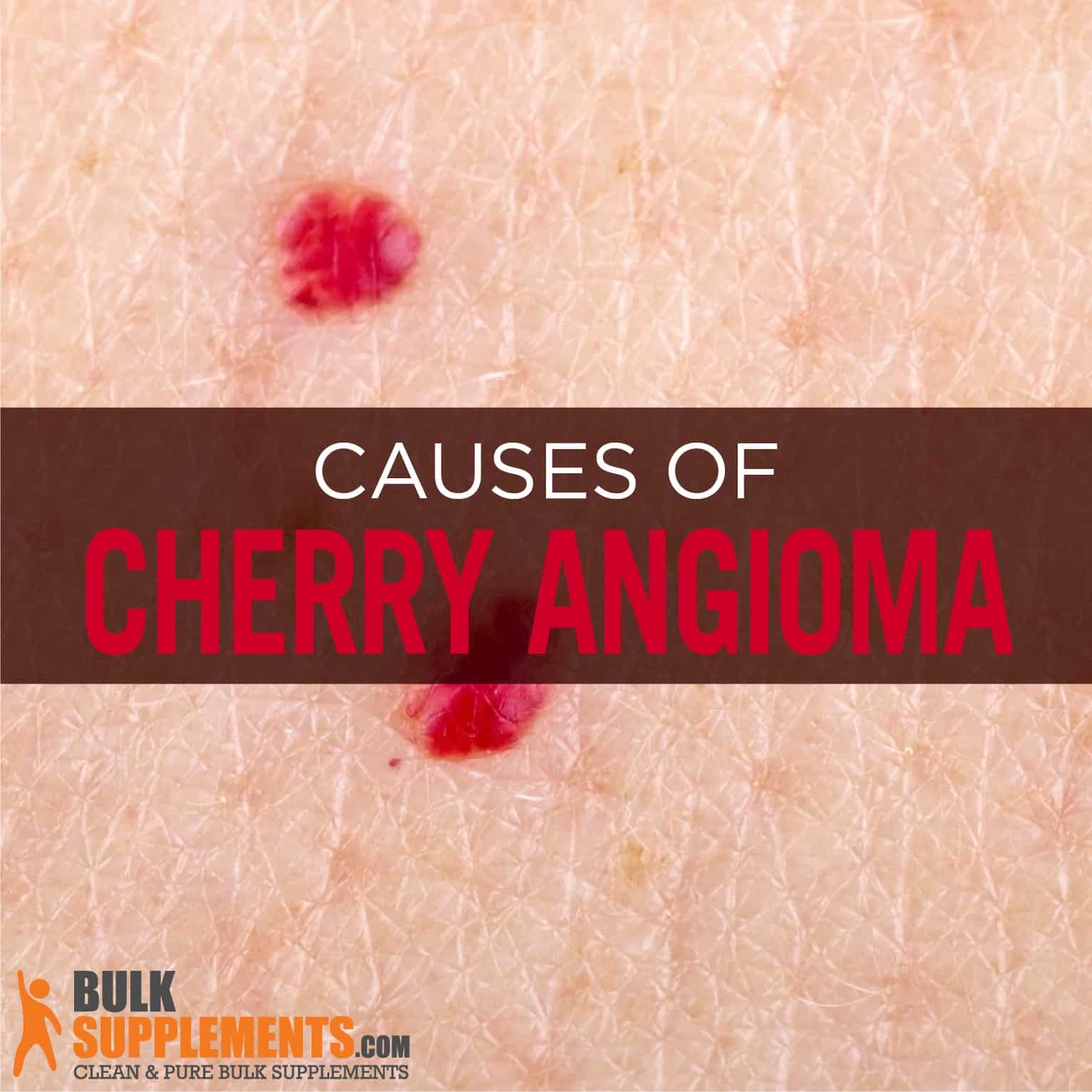 What Is Cherry Angioma? Causes, Symptoms, Risk Factors, and More