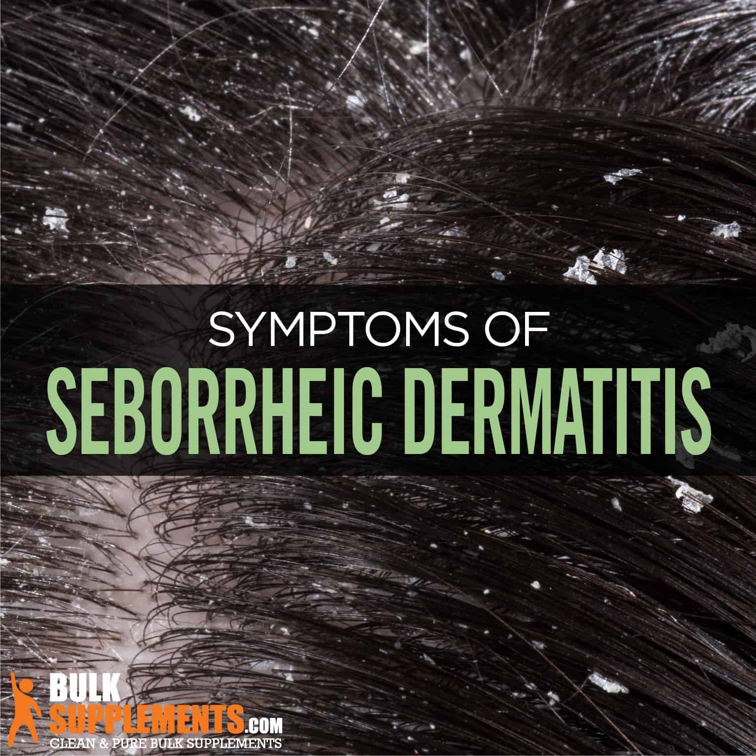 mild seborrheic dermatitis scalp