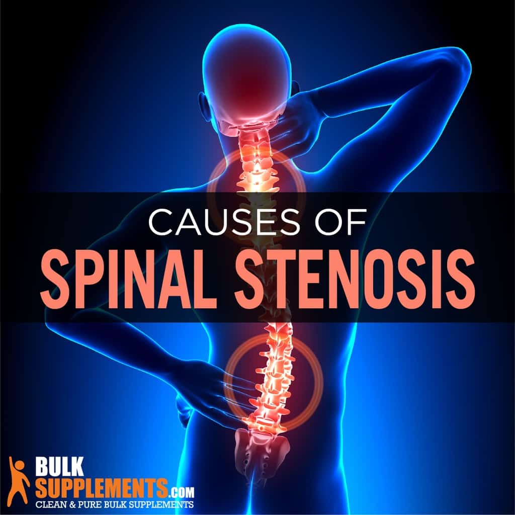 Spinal Stenosis Causes, Symptoms & Treatment